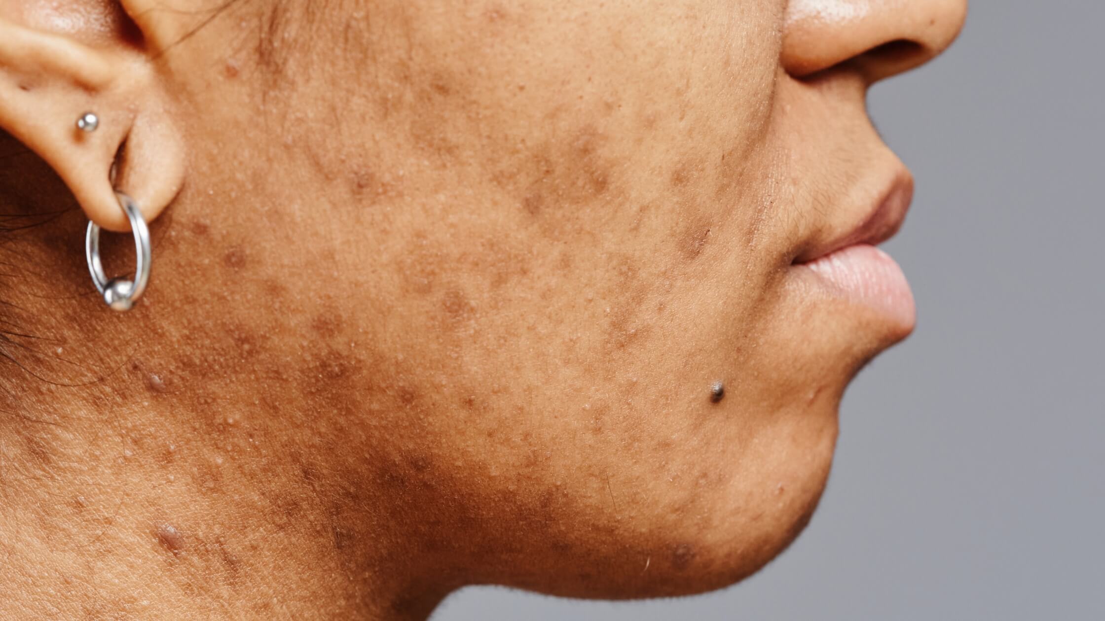 Is Benzoyl Peroxide Good for Dark Skin: What You Need to Know
